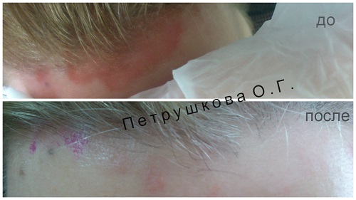 Лечение псориаза волосистой части головы лечение