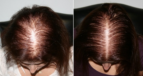 Плазмотерапия волос в Краснодаре у косметолога