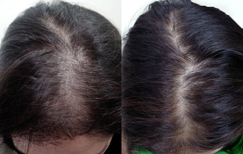 Плазмотерапия волос. Тел. 8 909 448-32-33 квалифицированный врач трихолог