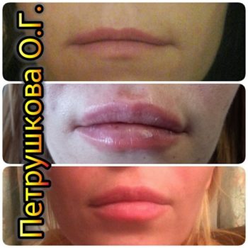 Фото увеличения губ у косметолога