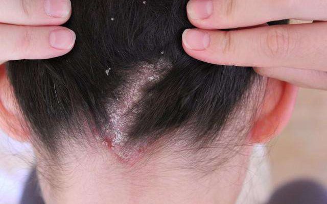 лечение псориаза волосистой части головы