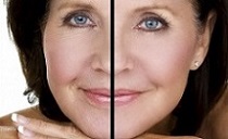 Мезонити. Фото до и после косметолога