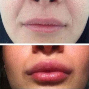 Коррекция губ в салоне Косметолог и Я