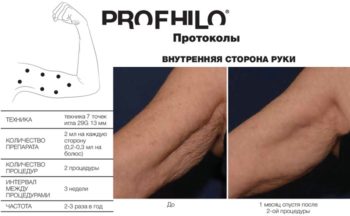 фото протокола инъекции профайло по внутренней поверхности плеча в Краснодаре