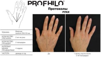 фото протокола инъекций профайло (profhilo ibsa) в кисти рук