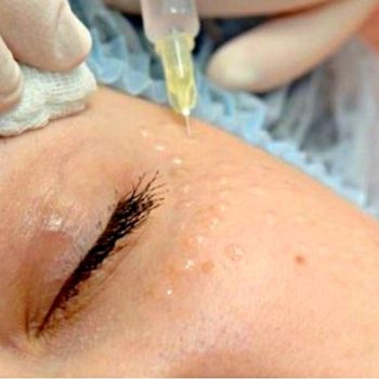 Цена на мезотерапию вокруг глаз в Краснодаре