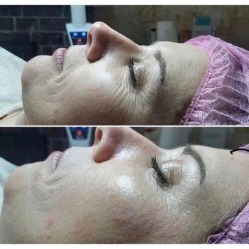 Фото до и после омоложения лица на аппарате Skindex 7-2