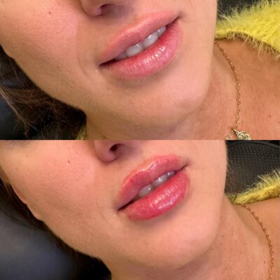 Teosyal Kiss филлер для губ фото до и после