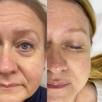 вакуумный массаж лица отзывы и фото до и после