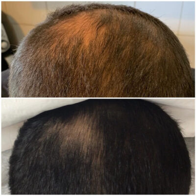 плазмотерапия для волос до и после