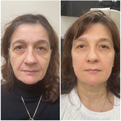 плазмотерапия фото до и после для лица