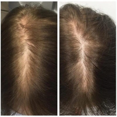 плазмотерапия волос до и после