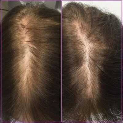 Мезотерапия для волос до и после