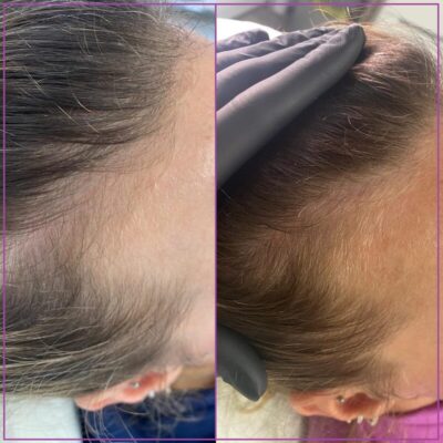 Мезотерапия для волос отзывы с фото