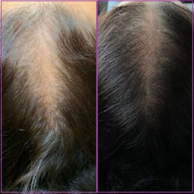 Мезотерапия волос до и после фото